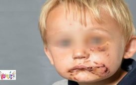 Κυπαρισσία: Ροτβάιλερ δάγκωσε στο πρόσωπο 2χρονο παιδάκι